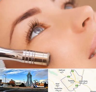 میکرودرم در تایباد