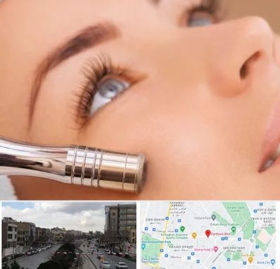 میکرودرم در بلوار فردوسی مشهد