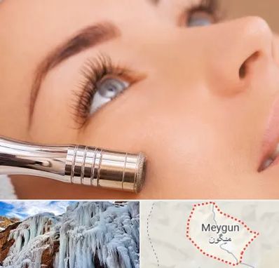 میکرودرم در میگون