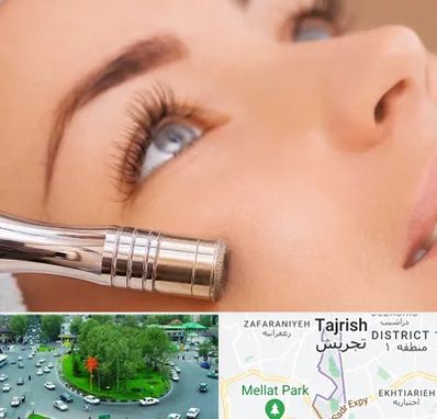 میکرودرم در تجریش 