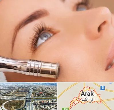 میکرودرم در اراک