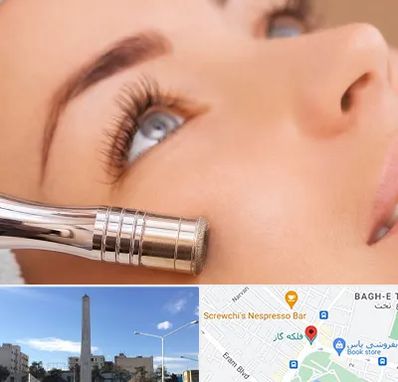 میکرودرم در فلکه گاز شیراز