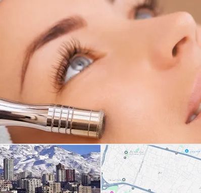 میکرودرم در ازگل