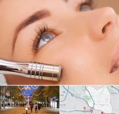 میکرودرم در ولیعصر ارومیه