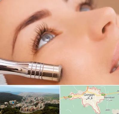 میکرودرم در گرگان