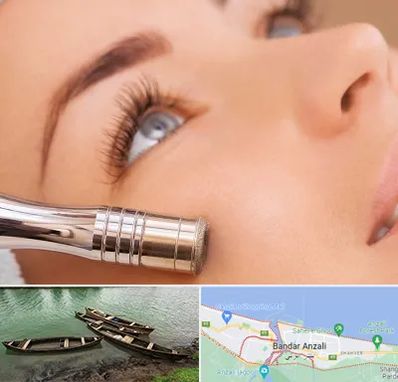 میکرودرم در بندر انزلی