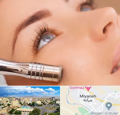 میکرودرم در میانه