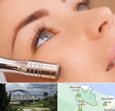 میکرودرم در چالوس