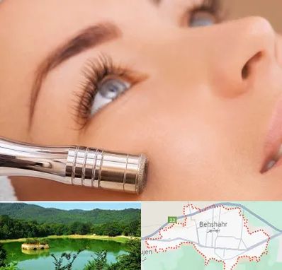 میکرودرم در بهشهر