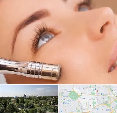 میکرودرم در منطقه 16 تهران 