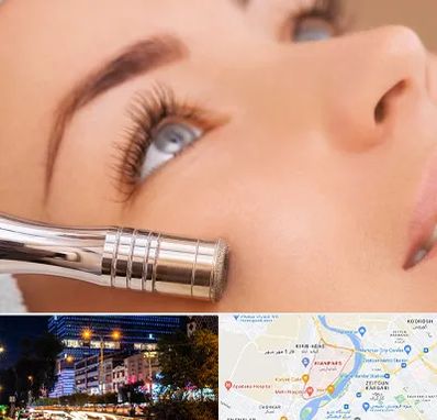 میکرودرم در کیانپارس اهواز