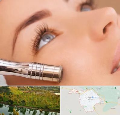 میکرودرم در بهبهان