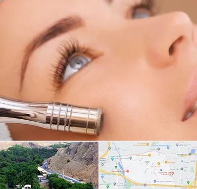 میکرودرم در کن 