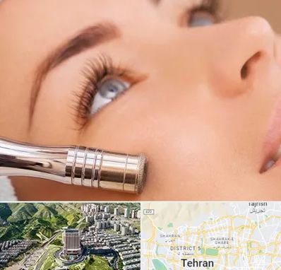 میکرودرم در شمال تهران 