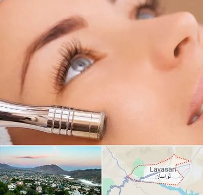 میکرودرم در لواسان