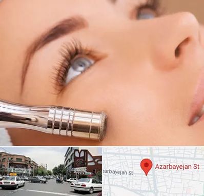 میکرودرم در خیابان آذربایجان