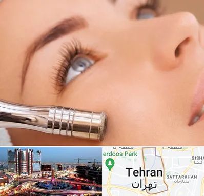 میکرودرم در صادقیه 