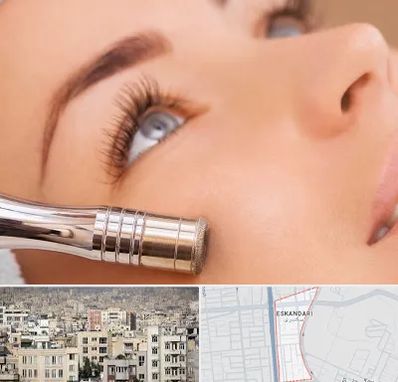 میکرودرم در اسکندری