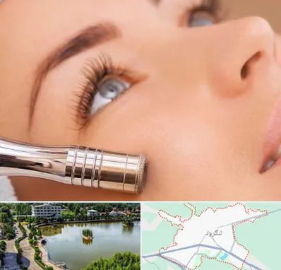 میکرودرم در لنگرود