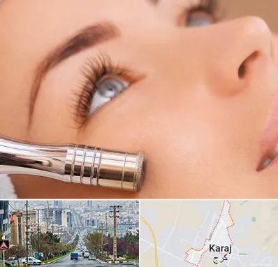 میکرودرم در گوهردشت کرج 