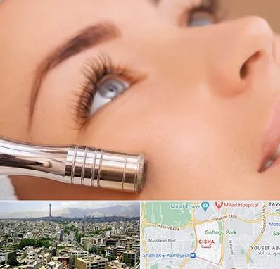 میکرودرم در گیشا 