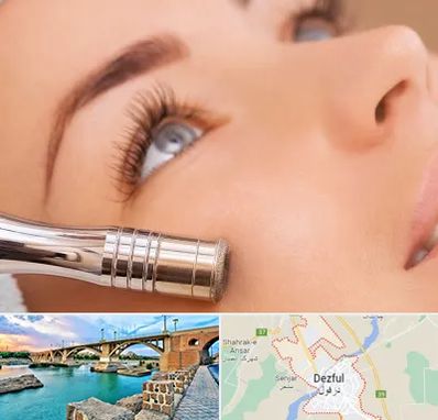 میکرودرم در دزفول