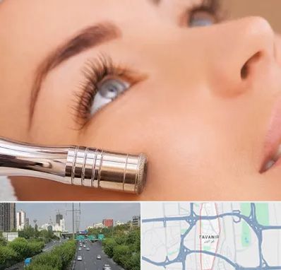 میکرودرم در توانیر