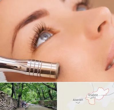 میکرودرم در شاندیز مشهد