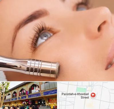 میکرودرم در 15 خرداد