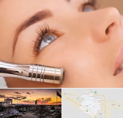 میکرودرم در قوچان