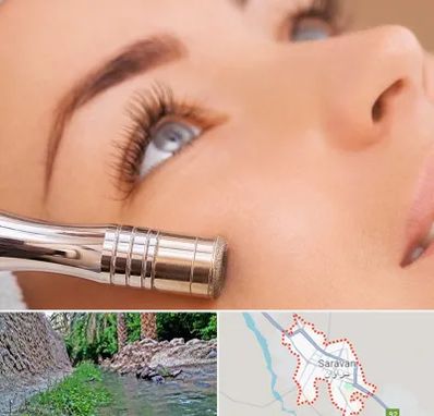 میکرودرم در سراوان