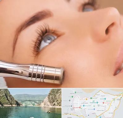 میکرودرم در ایلام