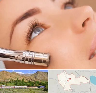 میکرودرم در خاش