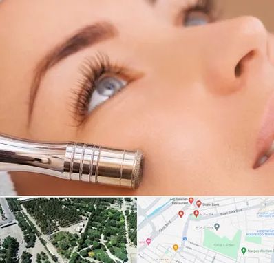 میکرودرم در سالاریه قم