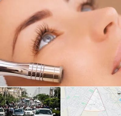 میکرودرم در سیدی مشهد