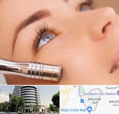 میکرودرم در قلهک 