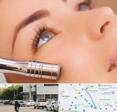 میکرودرم در قدوسی شرقی شیراز