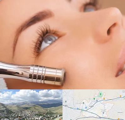 میکرودرم در رودهن