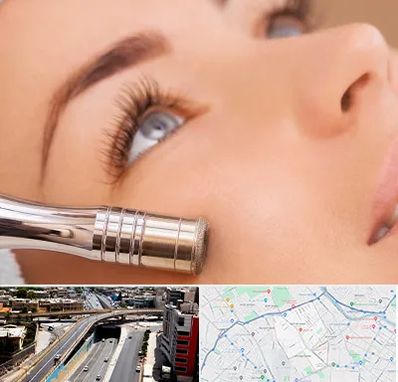 میکرودرم در ستارخان شیراز