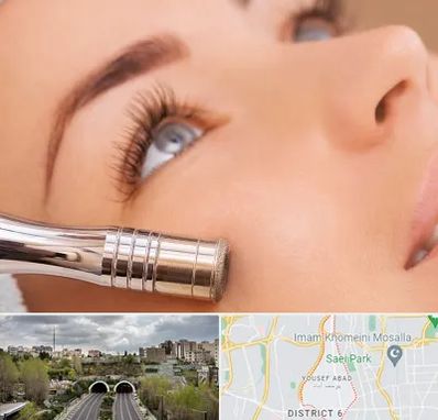 میکرودرم در یوسف آباد 