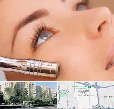 میکرودرم در آپادانا