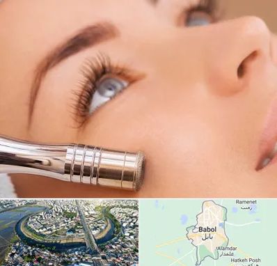 میکرودرم در بابل