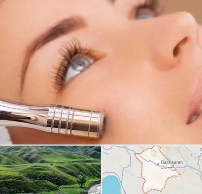 میکرودرم در گچساران