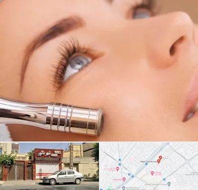 میکرودرم در باجک قم