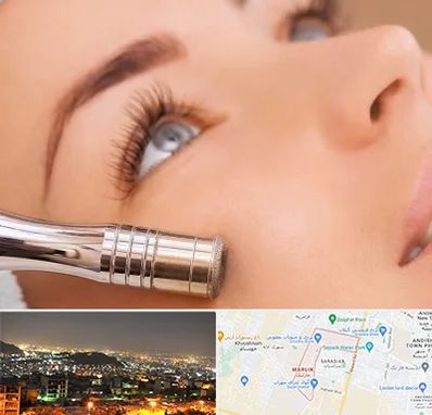 میکرودرم در مارلیک کرج