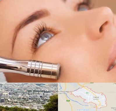 میکرودرم در یاسوج