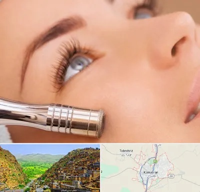 میکرودرم در کامیاران