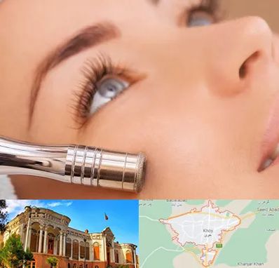 میکرودرم در خوی