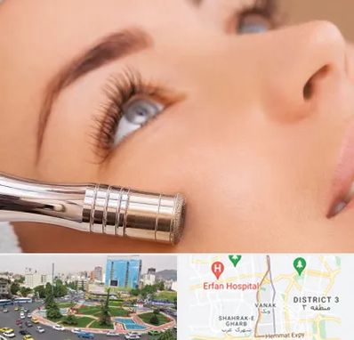 میکرودرم در ونک 