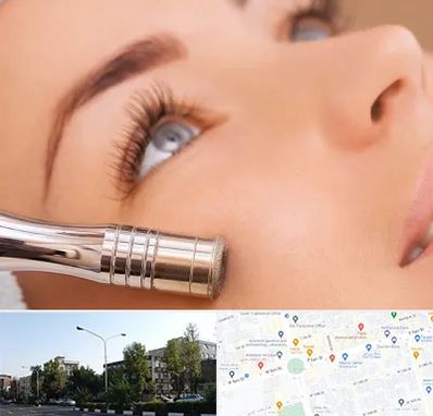 میکرودرم در میدان کاج 